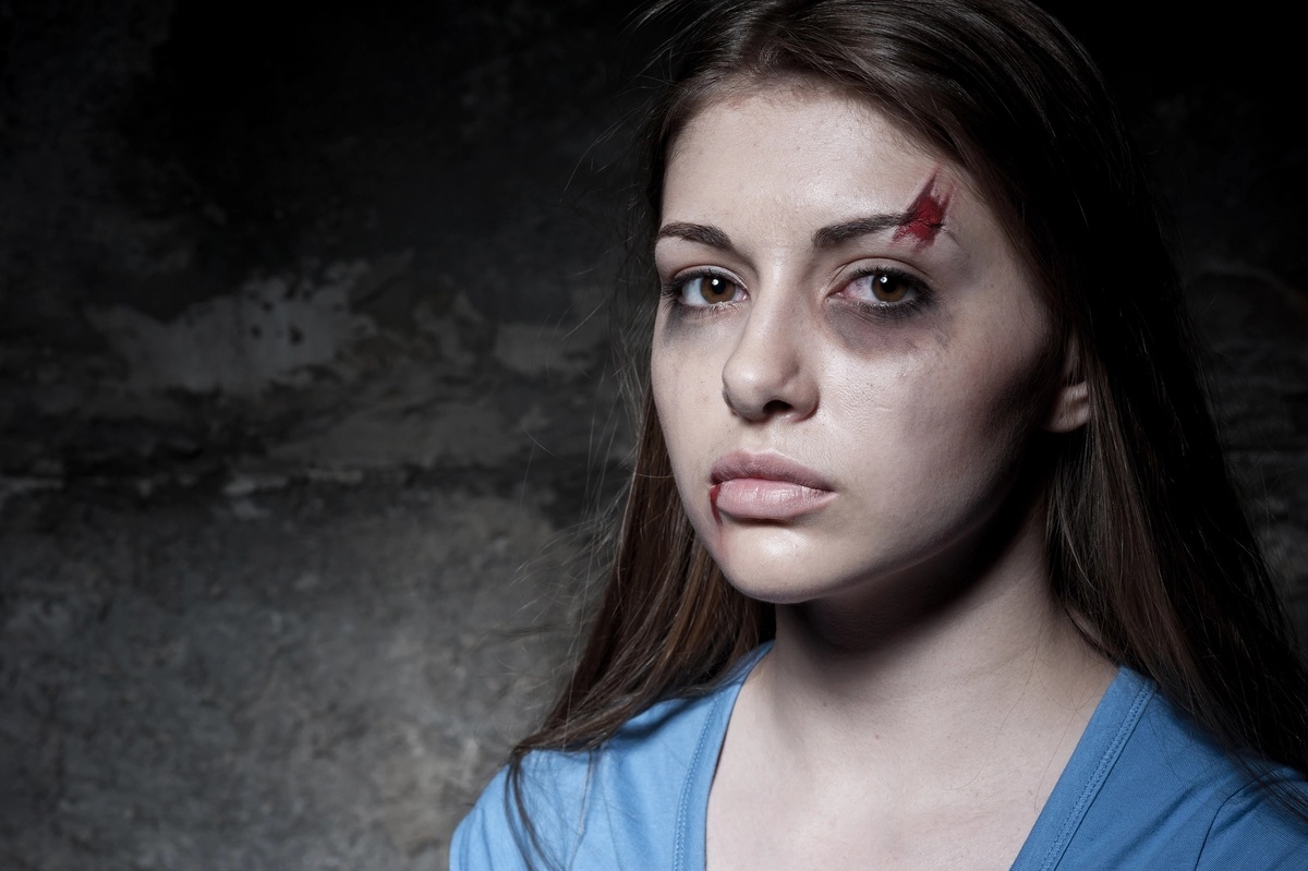 A woman looking at the camera with a bloody and bruised face.