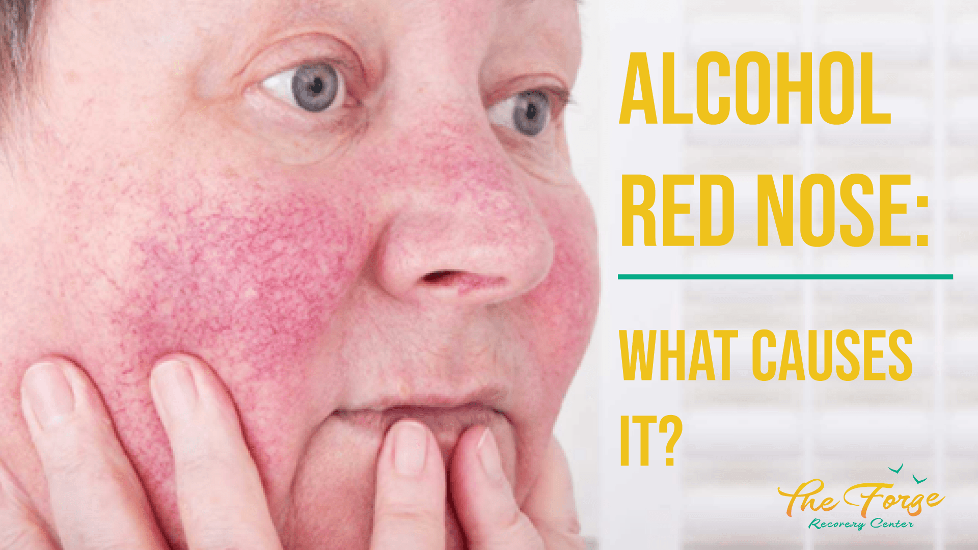 What is Alcohol Red Nose?