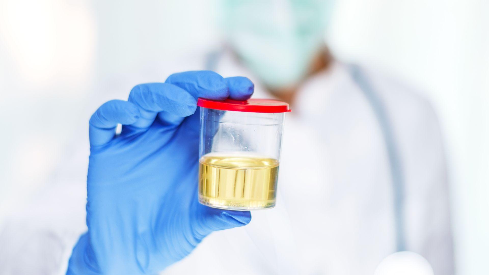 how long does oxycodone stay in your urine: Doctor holding urine sample