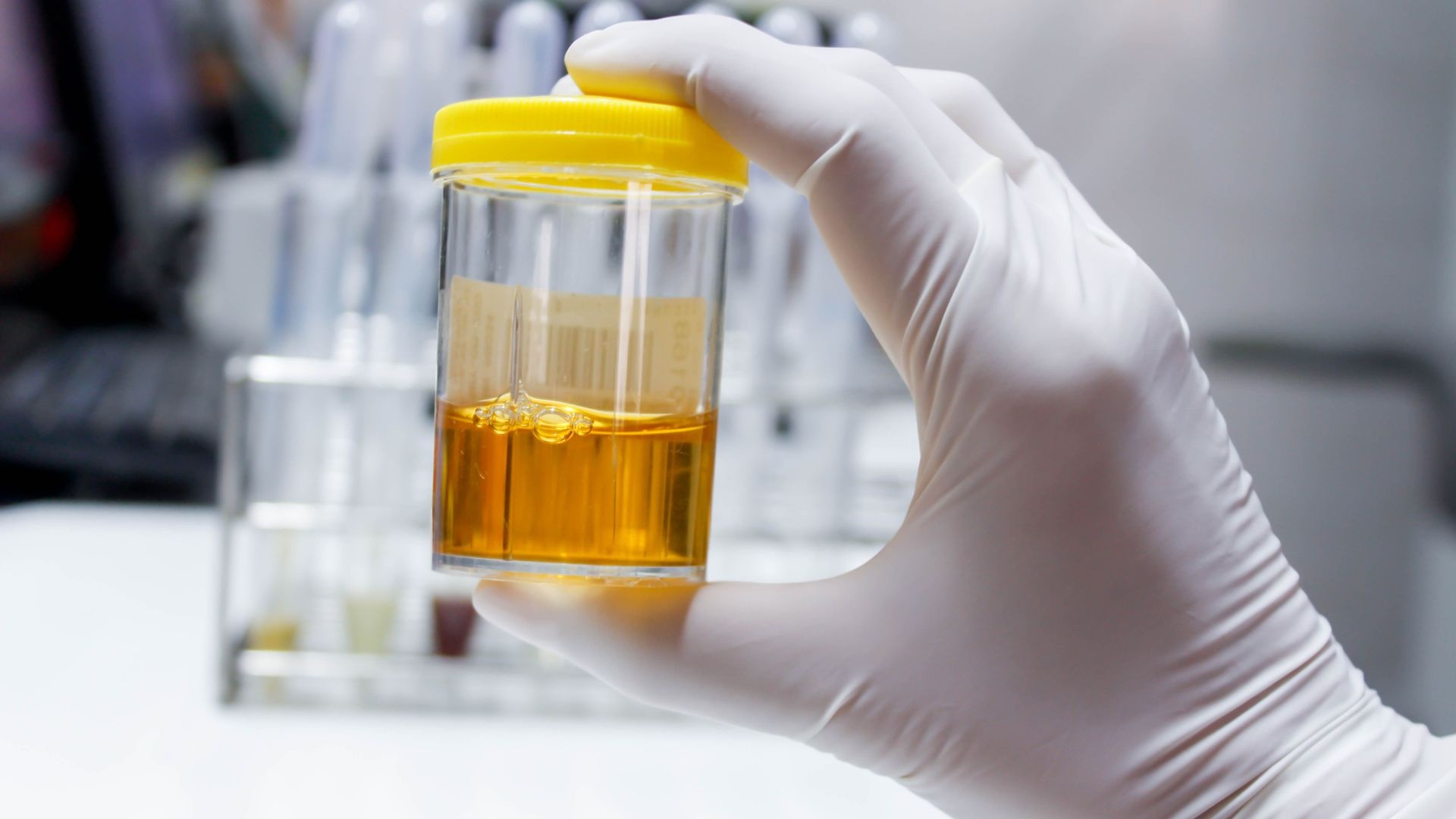 How long xanax stays in urine: Urine sample How long xanax stays in urine: Urine sample